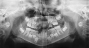  Dental Radiographs (X-Rays) - Pediatric Dentist in Ann Arbor, MI