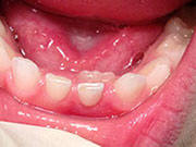 Baby Teeth - Pediatric Dentist in Ann Arbor, MI